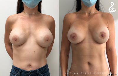 Breast Revision Before & After Gallery - Patient 262579 - Image 1