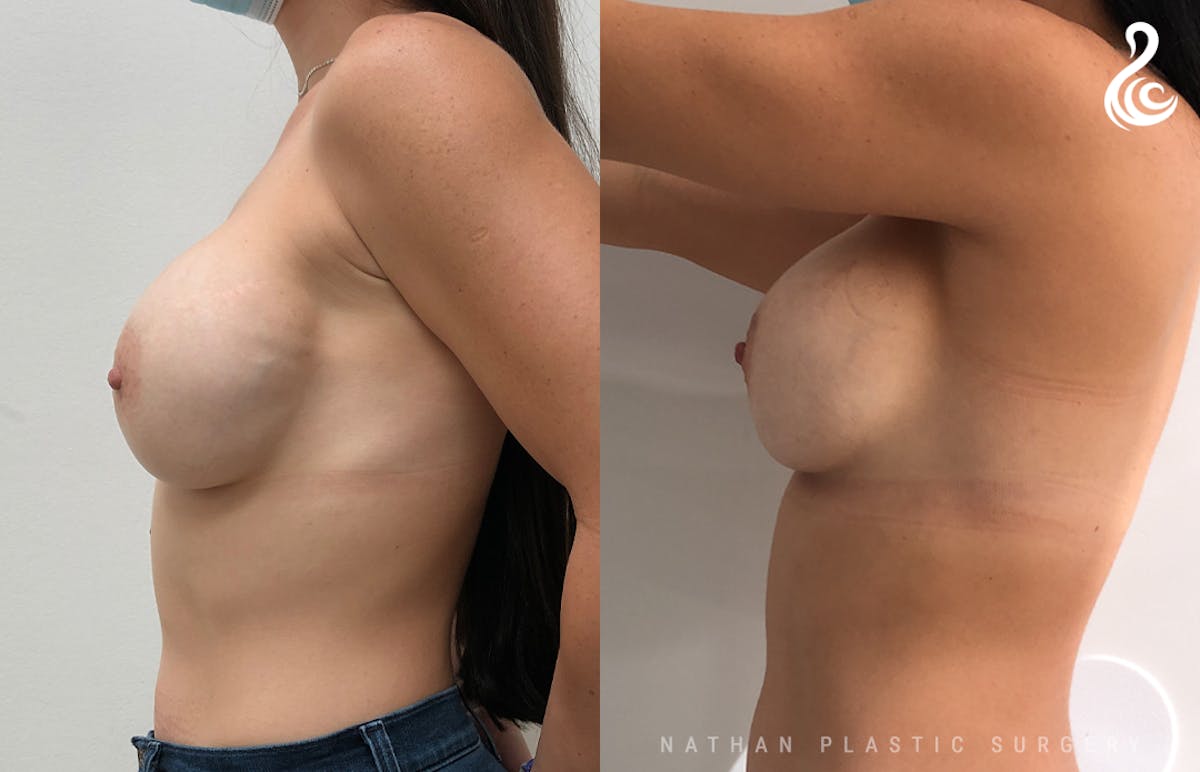 Breast Revision Before & After Gallery - Patient 262579 - Image 2