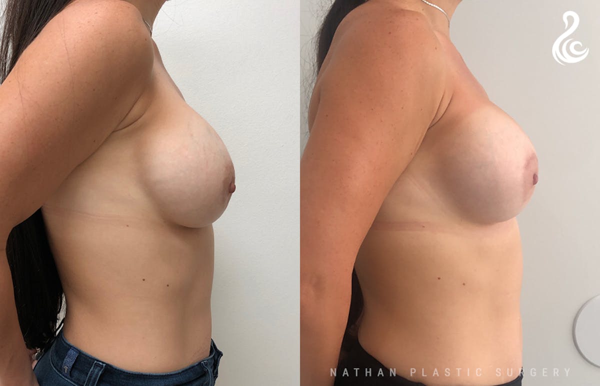 Breast Revision Before & After Gallery - Patient 262579 - Image 3