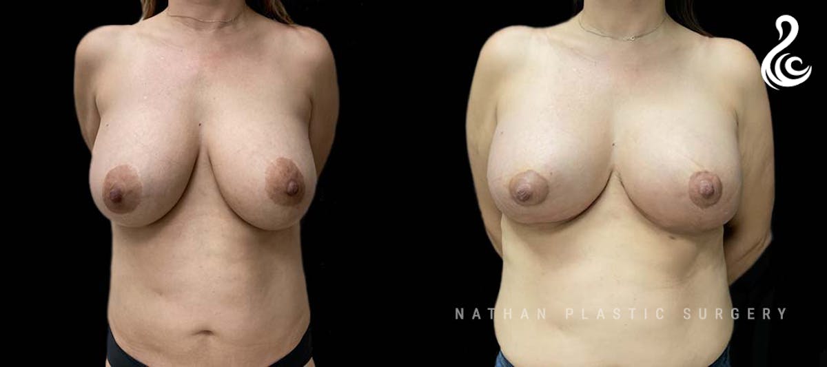 Breast Revision Before & After Gallery - Patient 102819 - Image 1