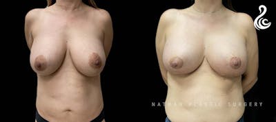 Breast Revision Before & After Gallery - Patient 102819 - Image 1