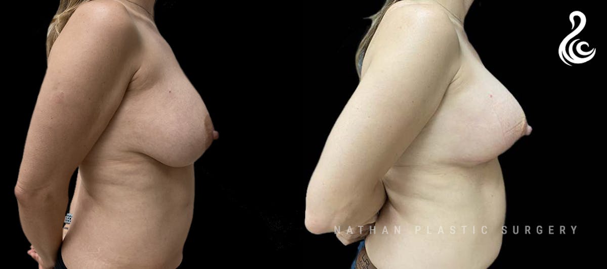 Breast Revision Before & After Gallery - Patient 102819 - Image 2