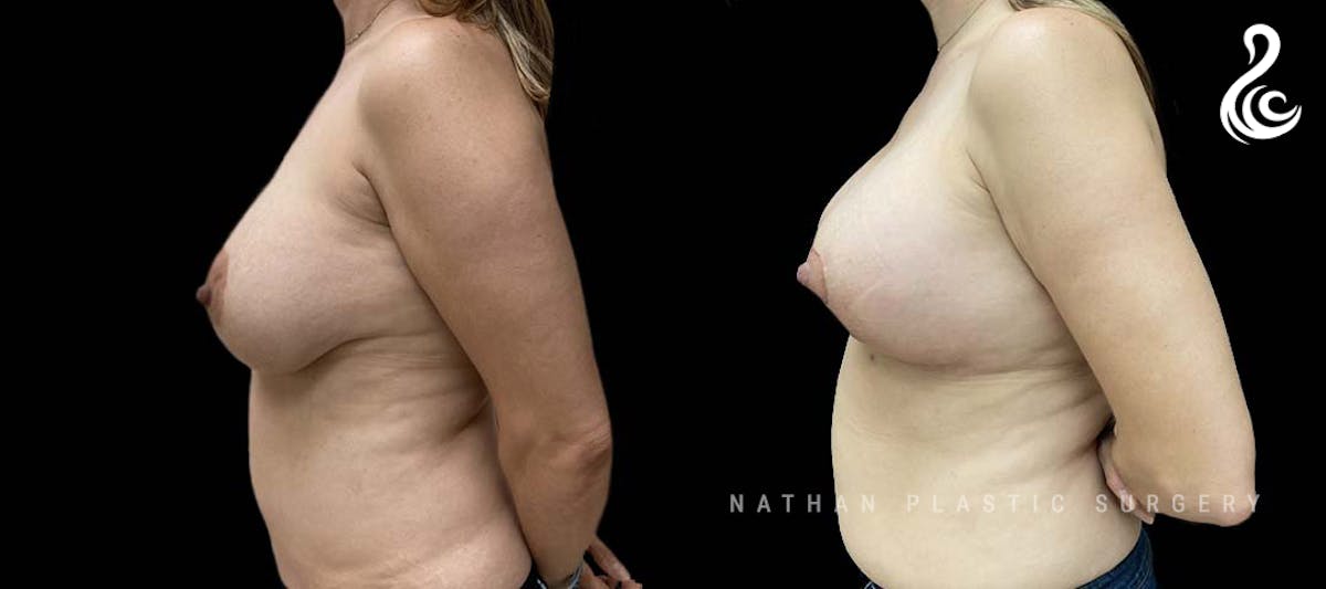 Breast Revision Before & After Gallery - Patient 102819 - Image 3