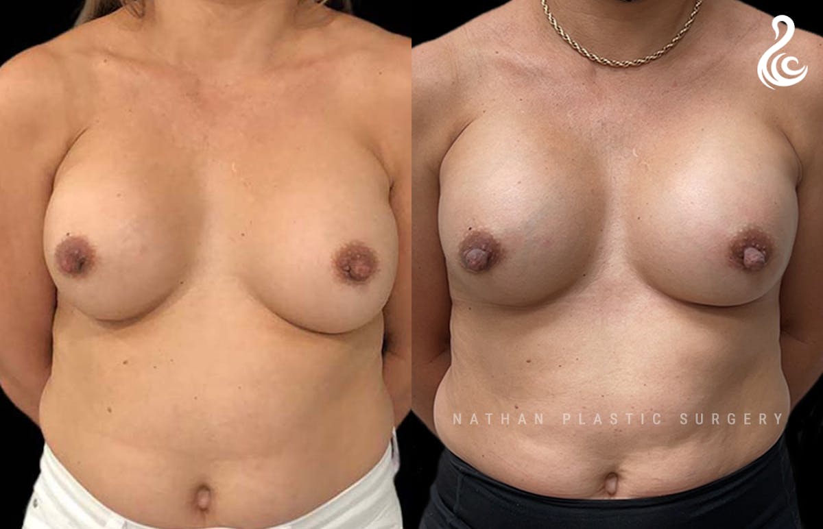 Breast Revision Before & After Gallery - Patient 285311 - Image 1