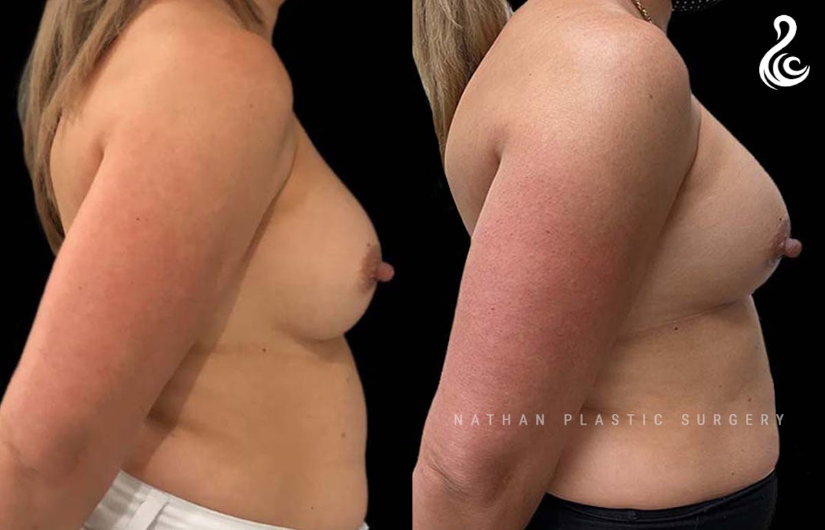 Breast Revision Before & After Gallery - Patient 285311 - Image 2