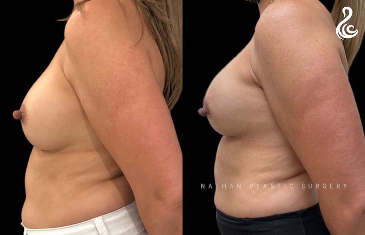 Breast Revision Before & After Gallery - Patient 285311 - Image 3