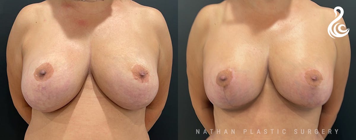 Breast Revision Before & After Gallery - Patient 217116 - Image 1