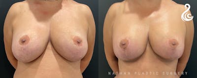 Breast Revision Before & After Gallery - Patient 217116 - Image 1