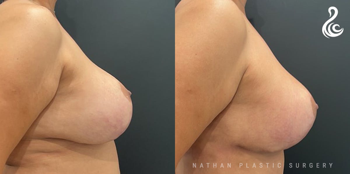 Breast Revision Before & After Gallery - Patient 217116 - Image 2