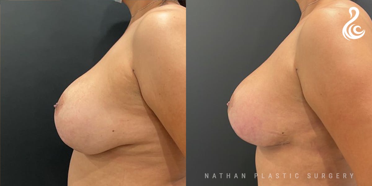 Breast Revision Before & After Gallery - Patient 217116 - Image 3