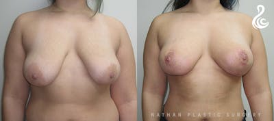 Fat Transfer Breast Augmentation Before & After Gallery - Patient 600771 - Image 1