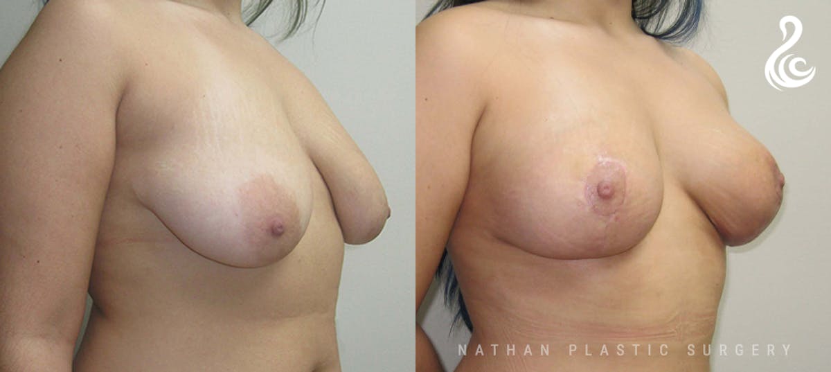 Fat Transfer Breast Augmentation Before & After Gallery - Patient 600771 - Image 2