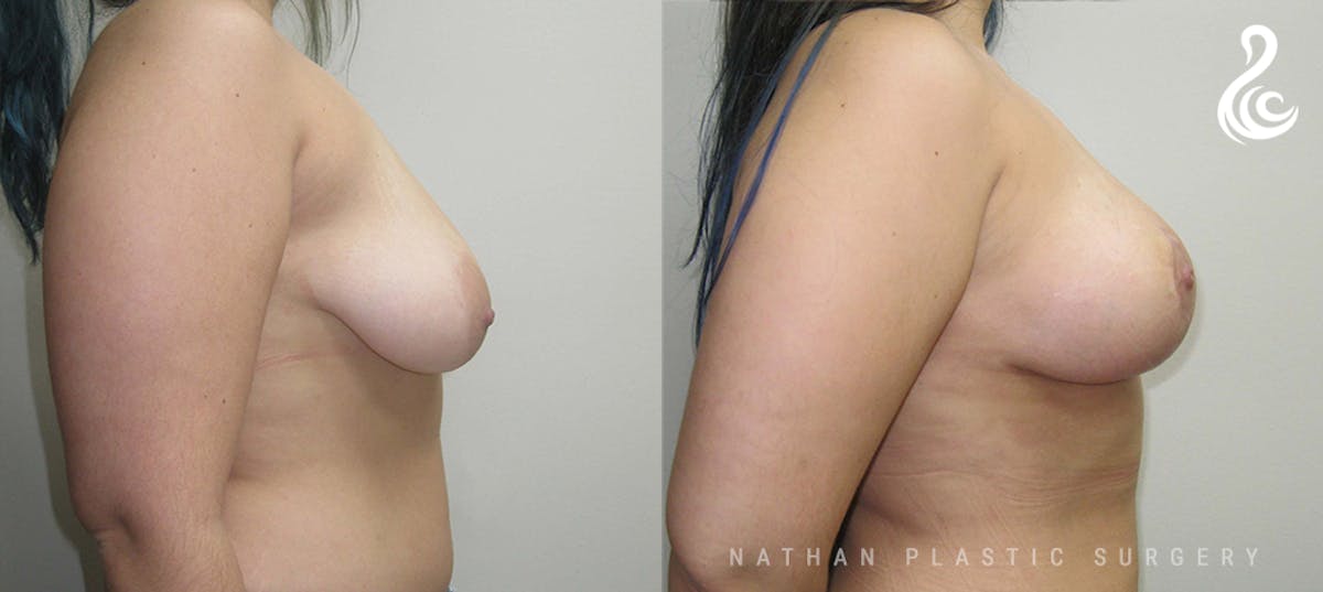 Fat Transfer Breast Augmentation Before & After Gallery - Patient 600771 - Image 3