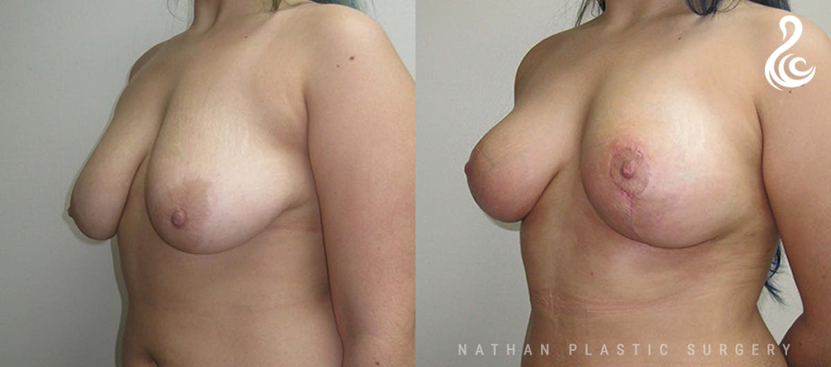 Fat Transfer Breast Augmentation Before & After Gallery - Patient 600771 - Image 4