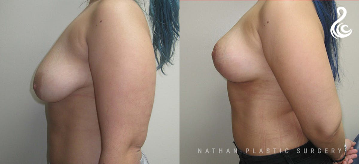 Fat Transfer Breast Augmentation Before & After Gallery - Patient 600771 - Image 5
