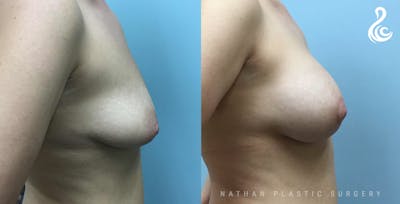 Breast Augmentation & Lift (Implants) Before & After Gallery - Patient 107503 - Image 1