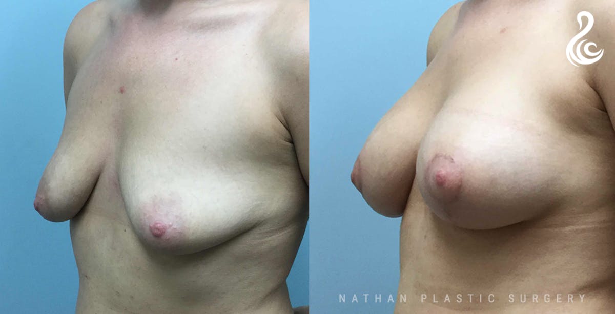 Breast Augmentation & Lift (Implants) Before & After Gallery - Patient 107503 - Image 2