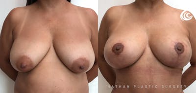 Breast Augmentation & Lift (Implants) Before & After Gallery - Patient 964723 - Image 1