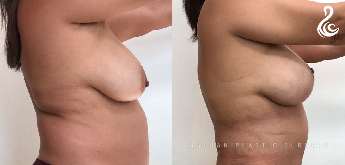 Breast Augmentation & Lift (Implants) Before & After Gallery - Patient 964723 - Image 2