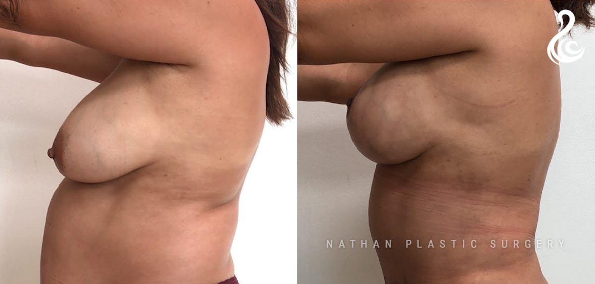 Breast Augmentation & Lift (Implants) Before & After Gallery - Patient 964723 - Image 3