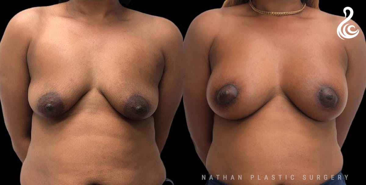Breast Augmentation & Lift (Implants) Before & After Gallery - Patient 238537 - Image 1