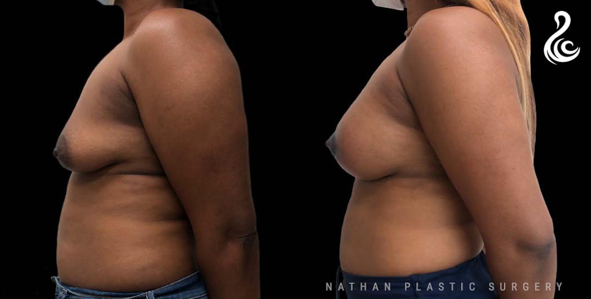 Breast Augmentation & Lift (Implants) Before & After Gallery - Patient 238537 - Image 2