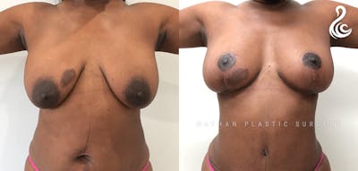 Breast Augmentation & Lift (Fat Grafting) Before & After Gallery - Patient 319075 - Image 1