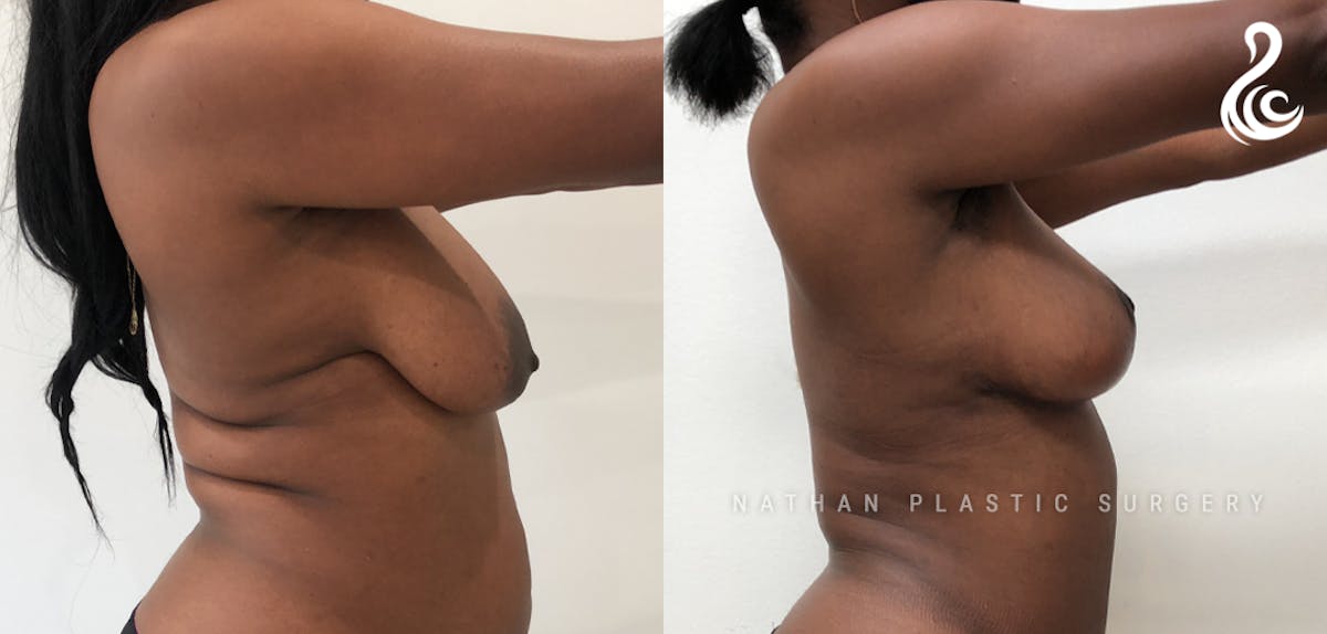 Breast Augmentation & Lift (Fat Grafting) Before & After Gallery - Patient 319075 - Image 2
