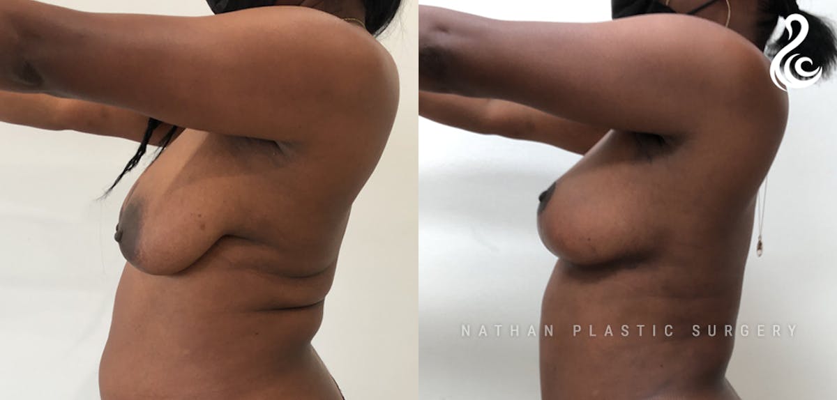Breast Augmentation & Lift (Fat Grafting) Before & After Gallery - Patient 319075 - Image 3