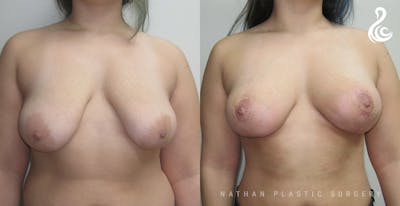 Breast Augmentation & Lift (Fat Grafting) Before & After Gallery - Patient 247978 - Image 1