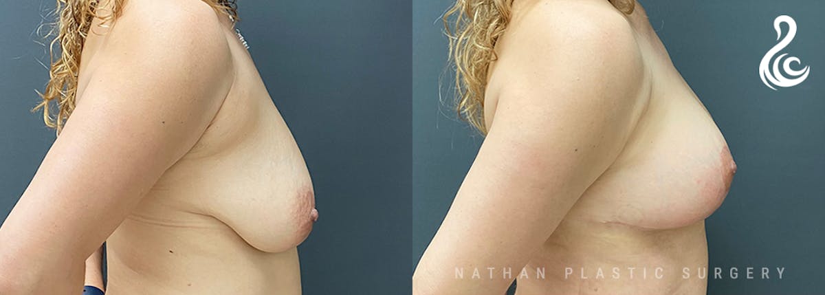 Breast Augmentation & Lift (Fat Grafting) Before & After Gallery - Patient 192182 - Image 3