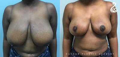Breast Reduction Before & After Gallery - Patient 229577 - Image 1