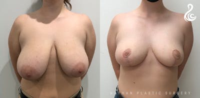 Breast Reduction Before & After Gallery - Patient 200679 - Image 1