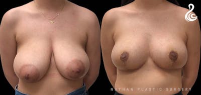 Breast Reduction Before & After Gallery - Patient 330371 - Image 1