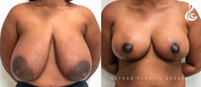 Breast Reduction Before & After Gallery - Patient 174071 - Image 1