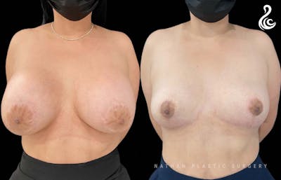 Breast Implant Removal (Breast Explant) Before & After Gallery - Patient 409259 - Image 1