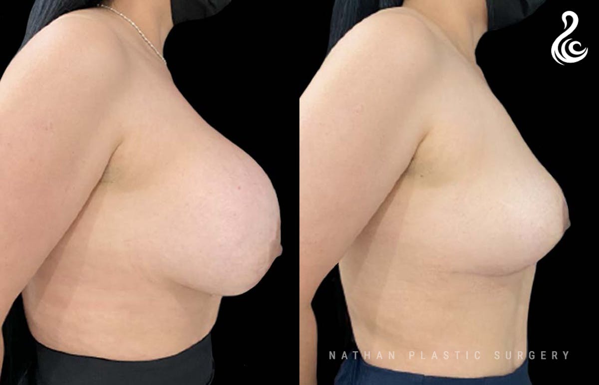 Breast Implant Removal (Breast Explant) Before & After Gallery - Patient 409259 - Image 2