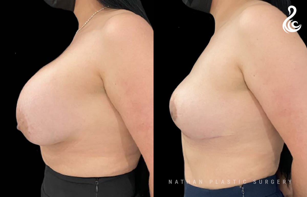 Breast Implant Removal (Breast Explant) Before & After Gallery - Patient 409259 - Image 3