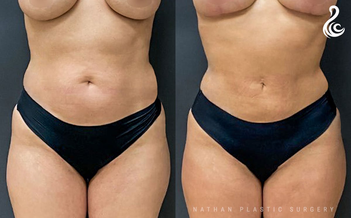 360 Liposuction Before & After Gallery - Patient 311236 - Image 1