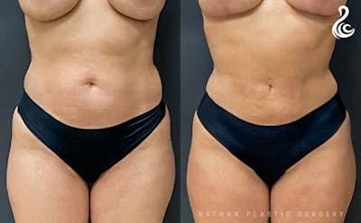 360 Liposuction Before & After Gallery - Patient 311236 - Image 1