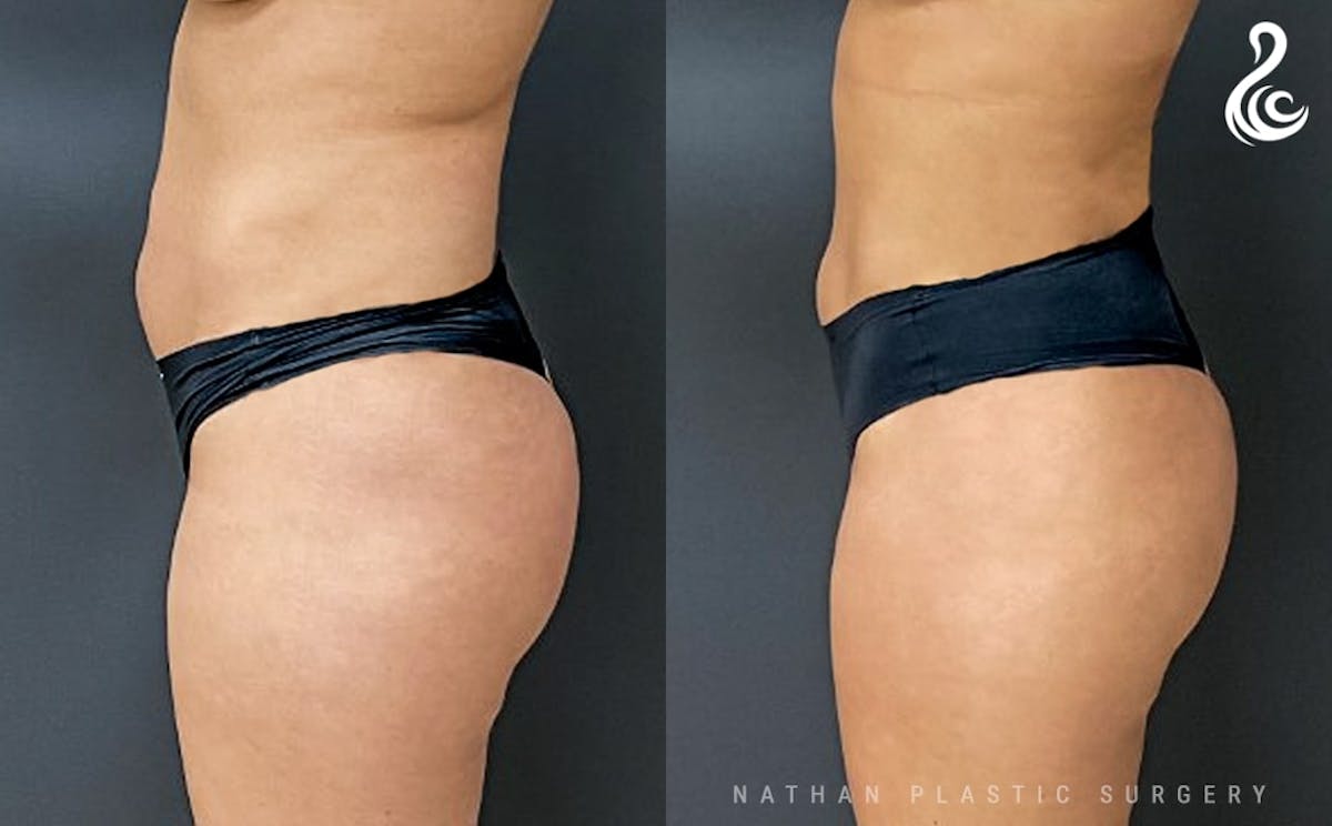 360 Liposuction Before & After Gallery - Patient 311236 - Image 2