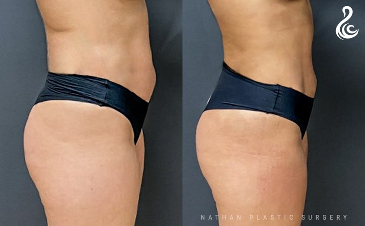 360 Liposuction Before & After Gallery - Patient 311236 - Image 3