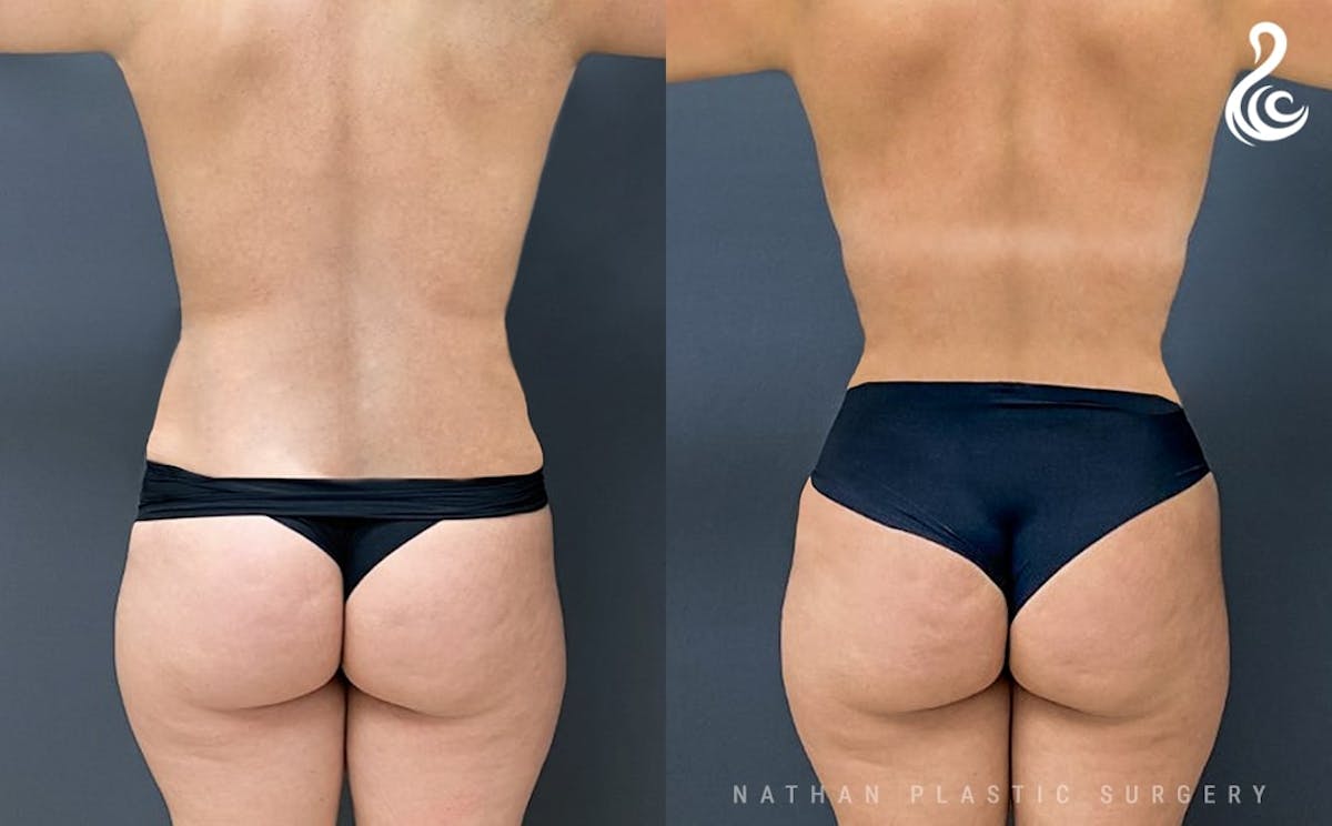 360 Liposuction Before & After Gallery - Patient 311236 - Image 4