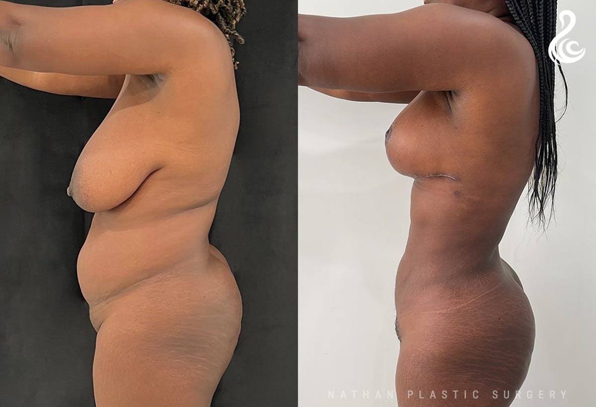 360 Liposuction Before & After Gallery - Patient 156164 - Image 2
