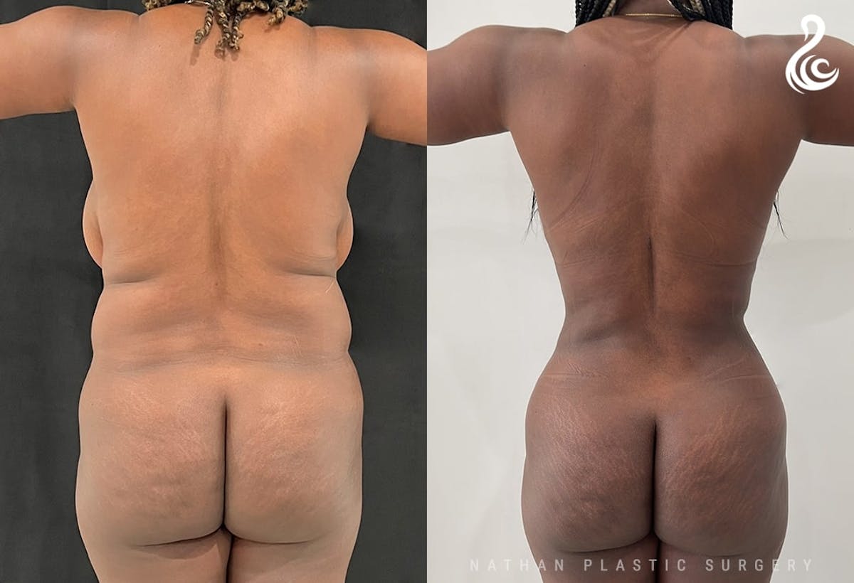 360 Liposuction Before & After Gallery - Patient 156164 - Image 4