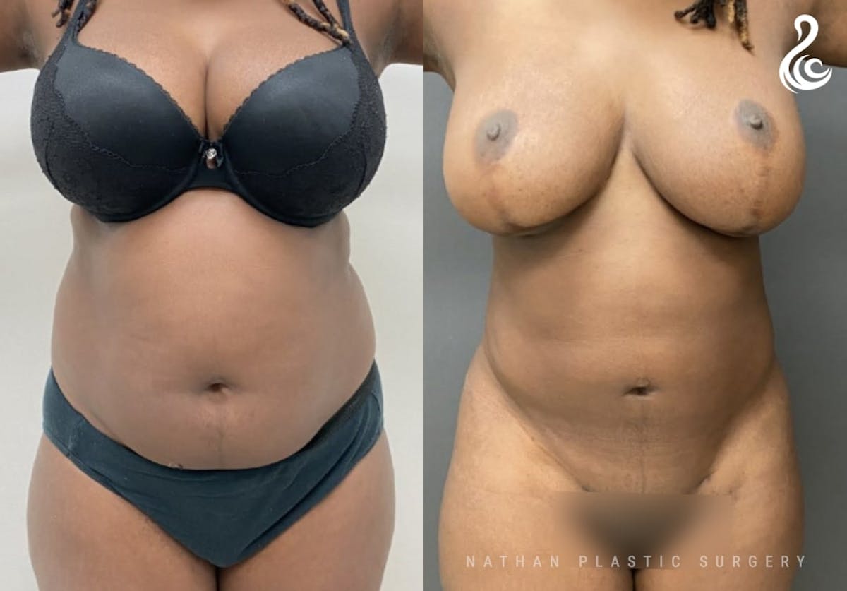 360 Liposuction Before & After Gallery - Patient 294366 - Image 1