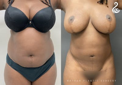 360 Liposuction Before & After Gallery - Patient 294366 - Image 1