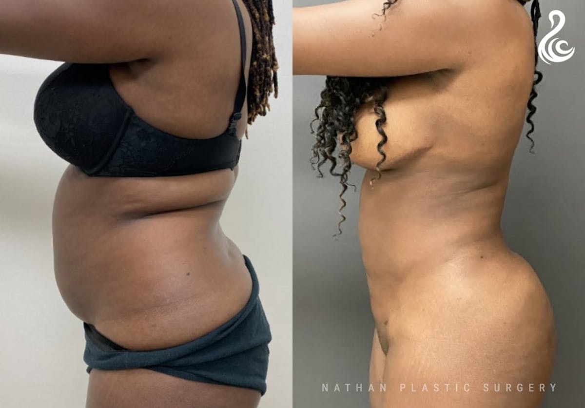 360 Liposuction Before & After Gallery - Patient 294366 - Image 2