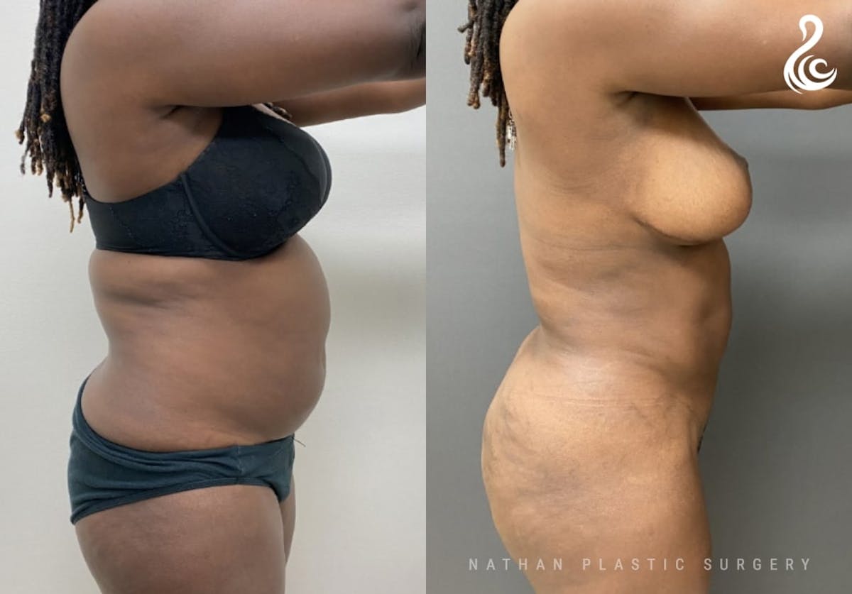 360 Liposuction Before & After Gallery - Patient 294366 - Image 3