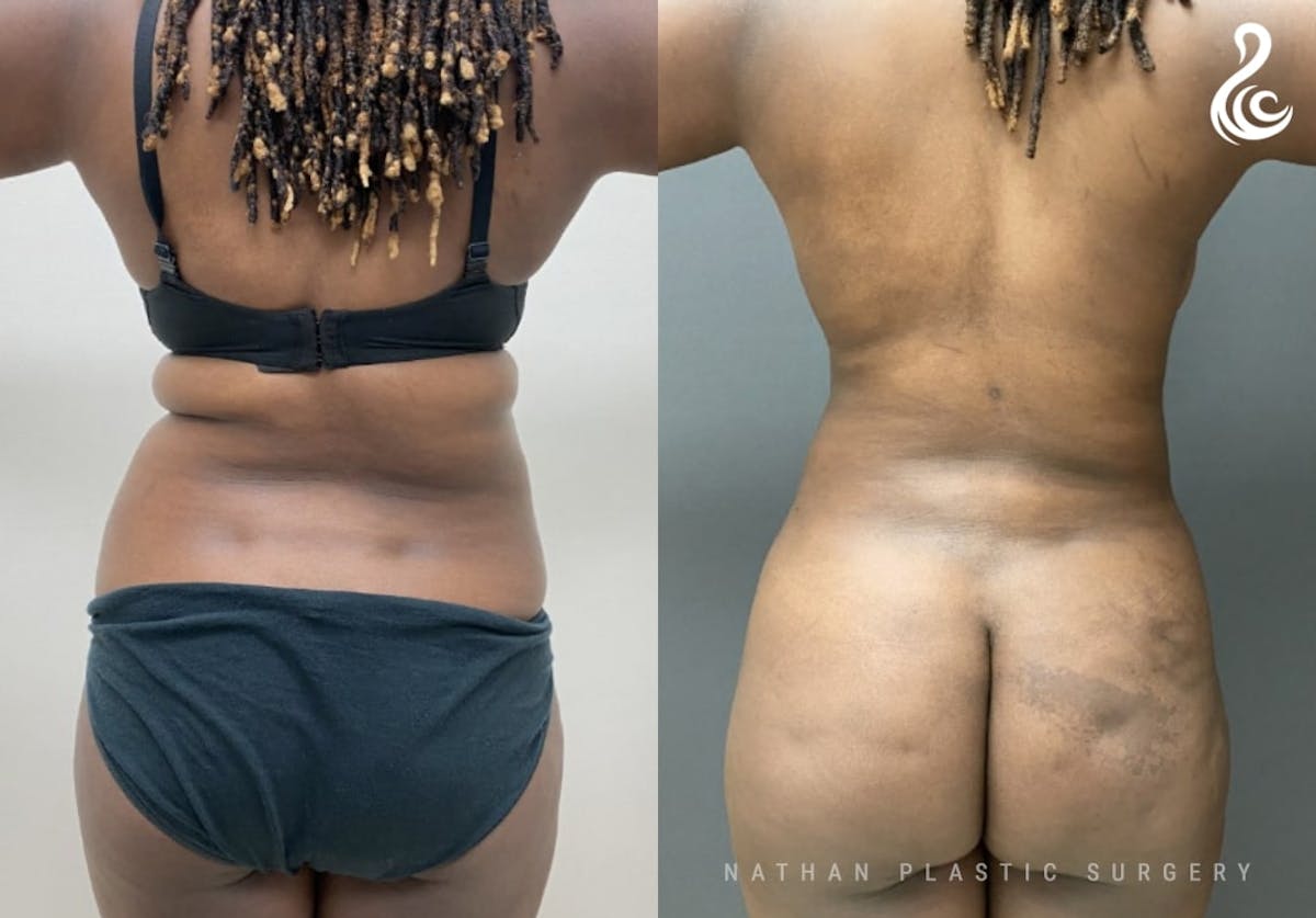 360 Liposuction Before & After Gallery - Patient 294366 - Image 4